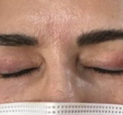 Alma Hybrid Scars after 5 sessions_Dr Arellano