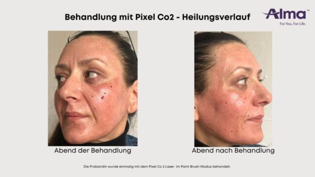 Wie lange dauert die Heilung nach einer Laserbehandlung?